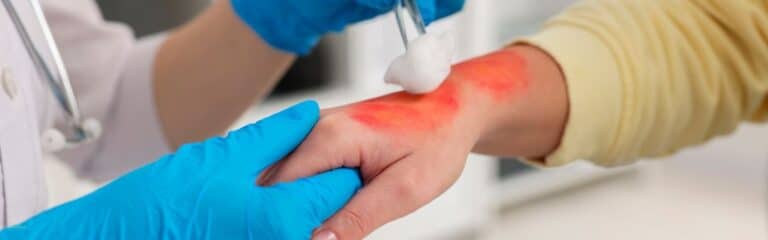 Scald Injuries
