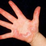 How To Prevent Scald Injuries On Young Children?