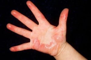 Scald Injury